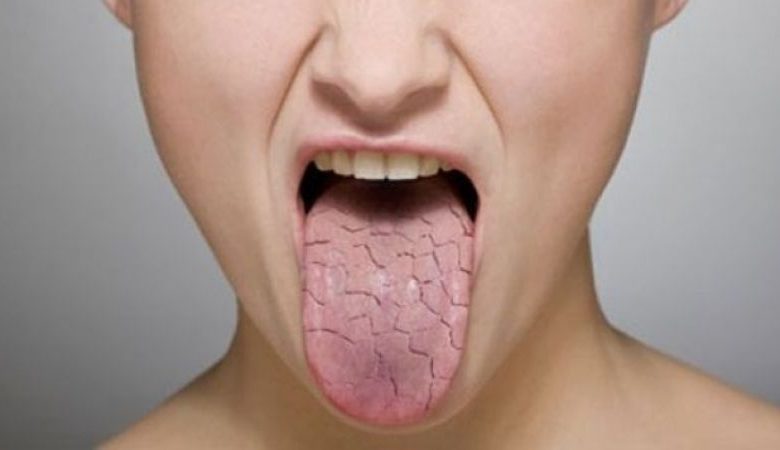 Wie kommt es zur Gelbfärbung der Zunge? Wie kommt es zur Gelbfärbung der Zunge?