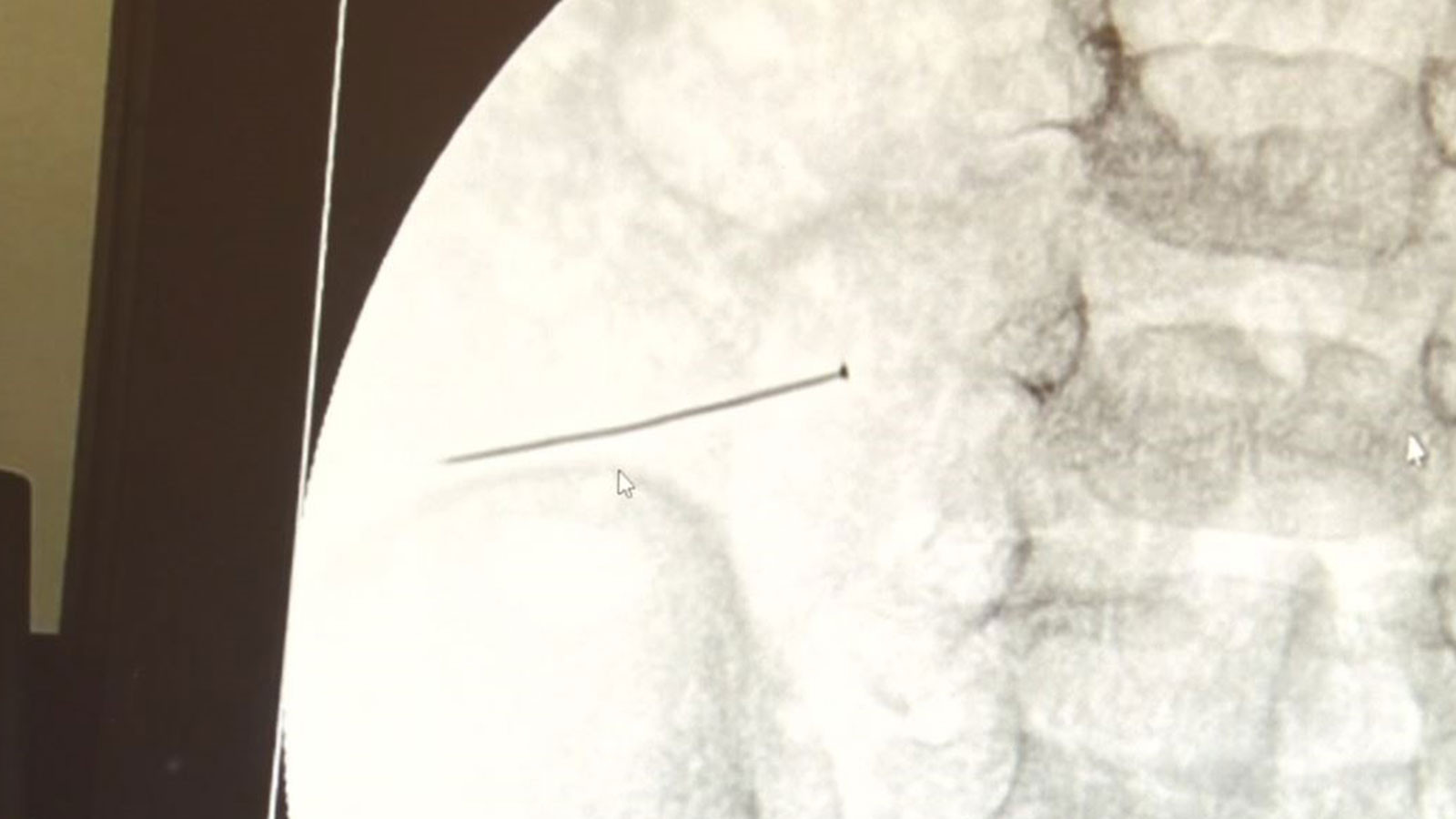 İstanbul’da 2 Yaşındaki Çocuğun Karnından 3 Santimlik İğne