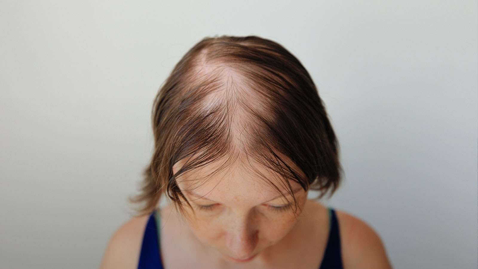 Saç Dökülmesi Sağlık Sorunlarının Belirtisi Olabilir Saç Dökülmesi Sağlık Sorunlarının Belirtisi Olabilir