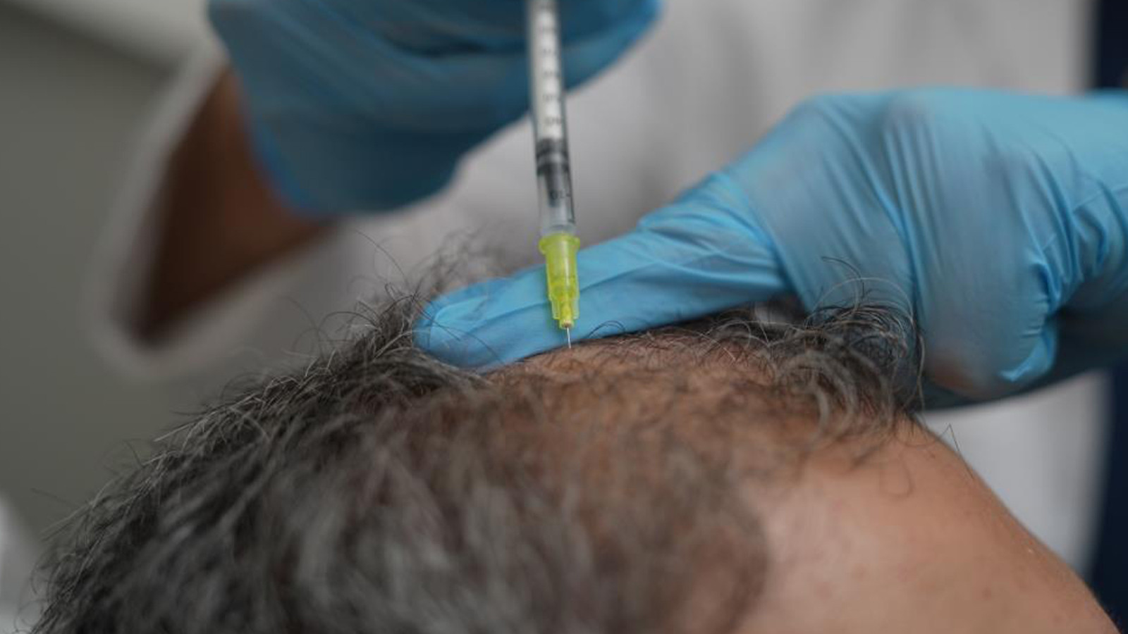 Saç Dökülmesi Sağlık Sorunlarının Belirtisi Olabilir Saç Dökülmesi Sağlık Sorunlarının Belirtisi Olabilir