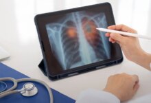 Dünya Sağlık Örgütü’ne Göre Akciğer Kanseri Tehlikesi