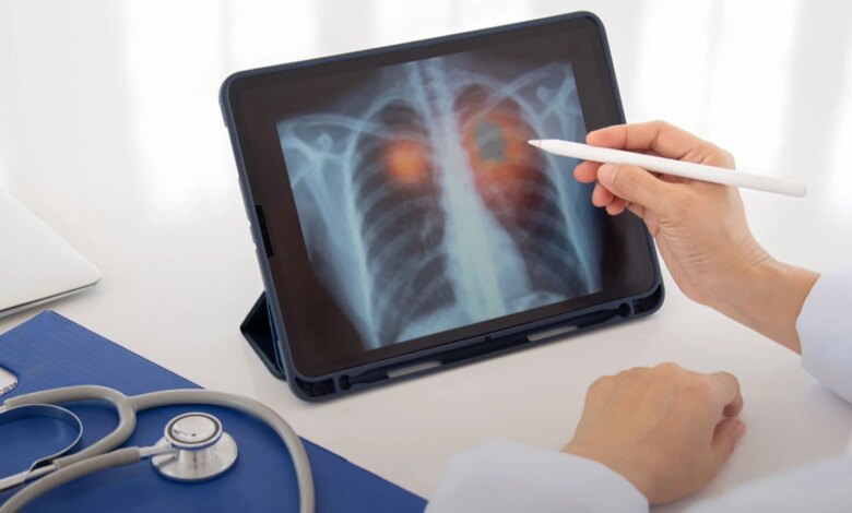 Dünya Sağlık Örgütü’ne Göre Akciğer Kanseri Tehlikesi