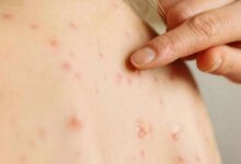 Dünya genelinde kızamık vakaları son 25 yılın zirvesinde