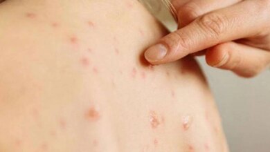 Dünya genelinde kızamık vakaları son 25 yılın zirvesinde