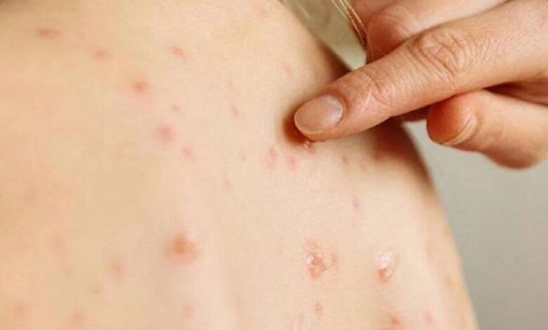 Dünya genelinde kızamık vakaları son 25 yılın zirvesinde