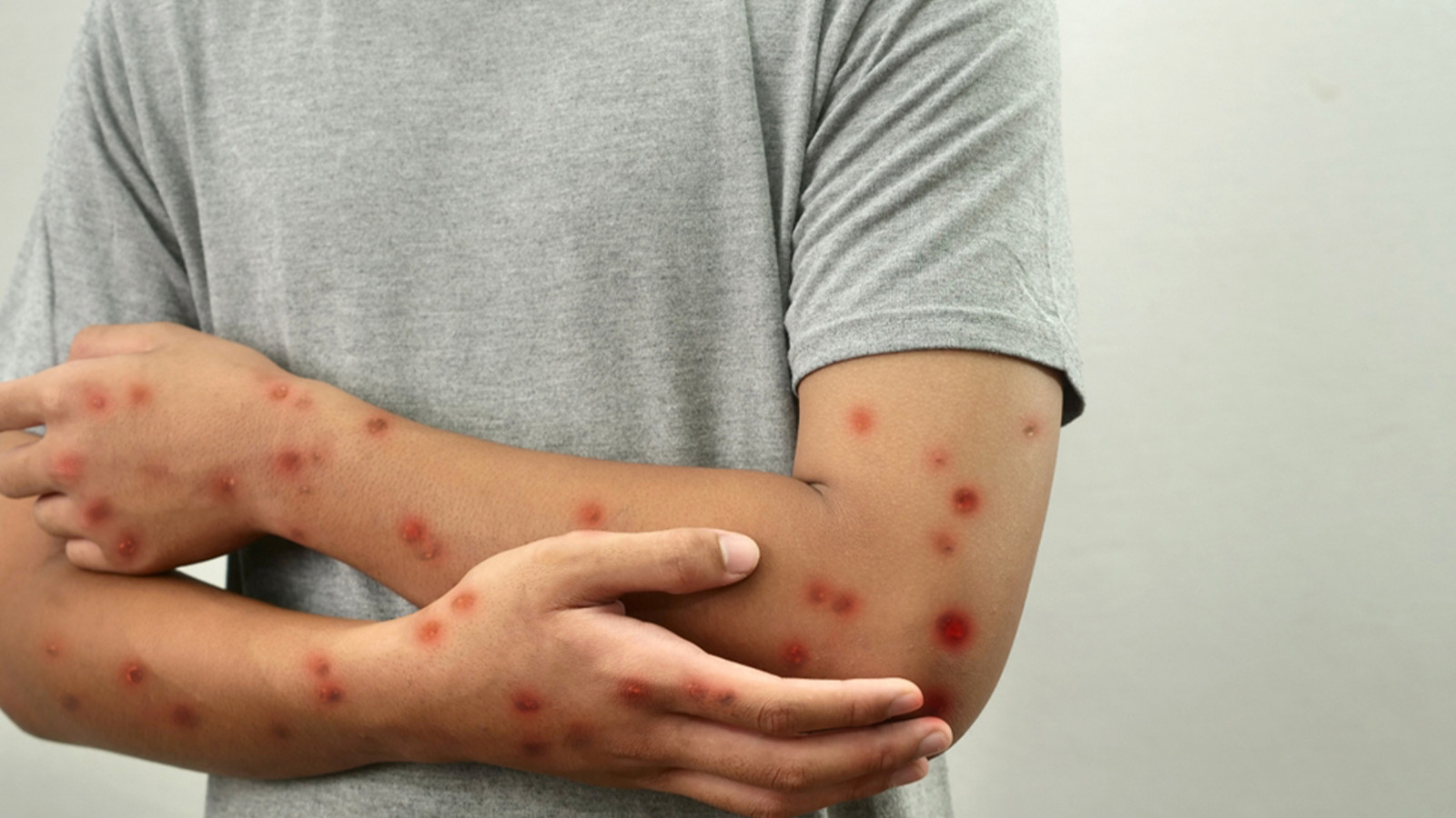 Maymun Çiçeği Virüsü Türkiye’de Görülmedi, Uzmanlar Uyarıyor Maymun Çiçeği Virüsü Türkiye’de Görülmedi, Uzmanlar Uyarıyor